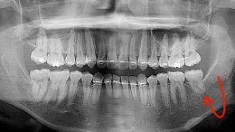 寿命 た 神経 抜い を 歯 神経を抜いた歯の寿命は短い？長持ちさせるには？｜さつきデンタルクリニック